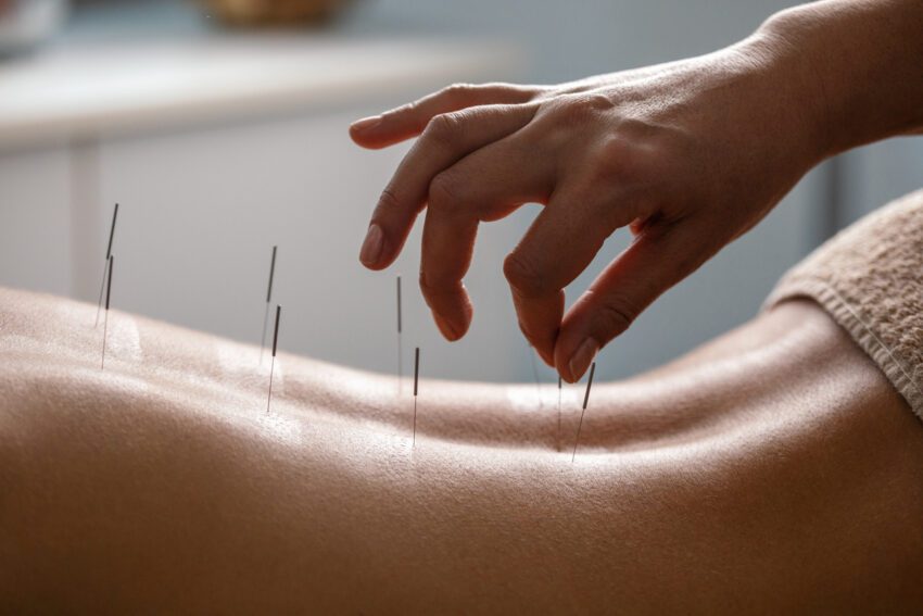 Acupuncture for Tinnitus