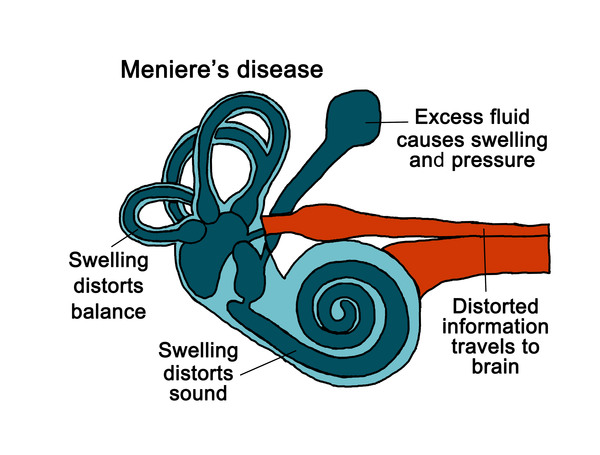 Science Behind Tinnitus-Related Dizziness