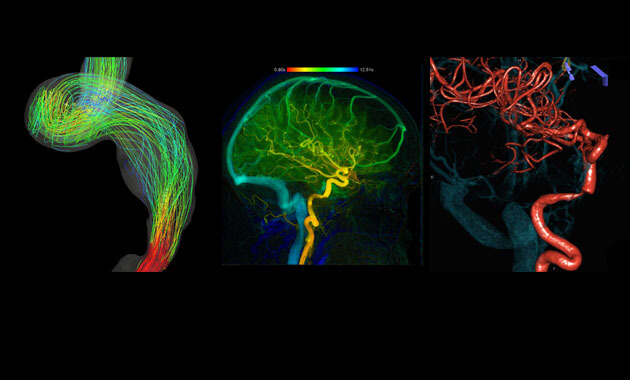 pulsatile tinnitus cases stem from vascular issues