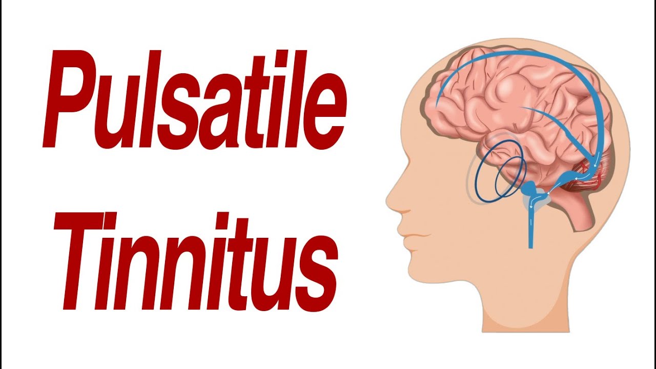 What Is Pulsatile Tinnitus