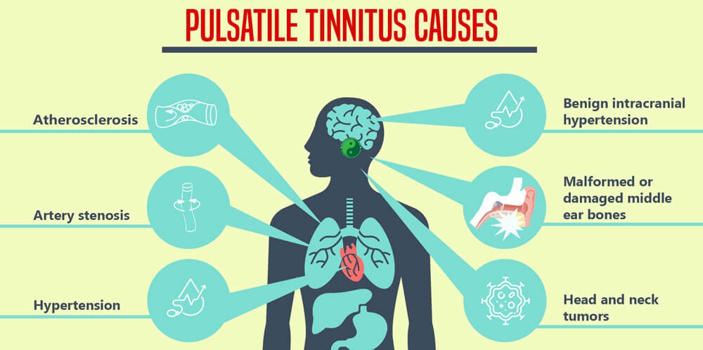some people experience pulsatile tinnitus without having significant vascular malformations
