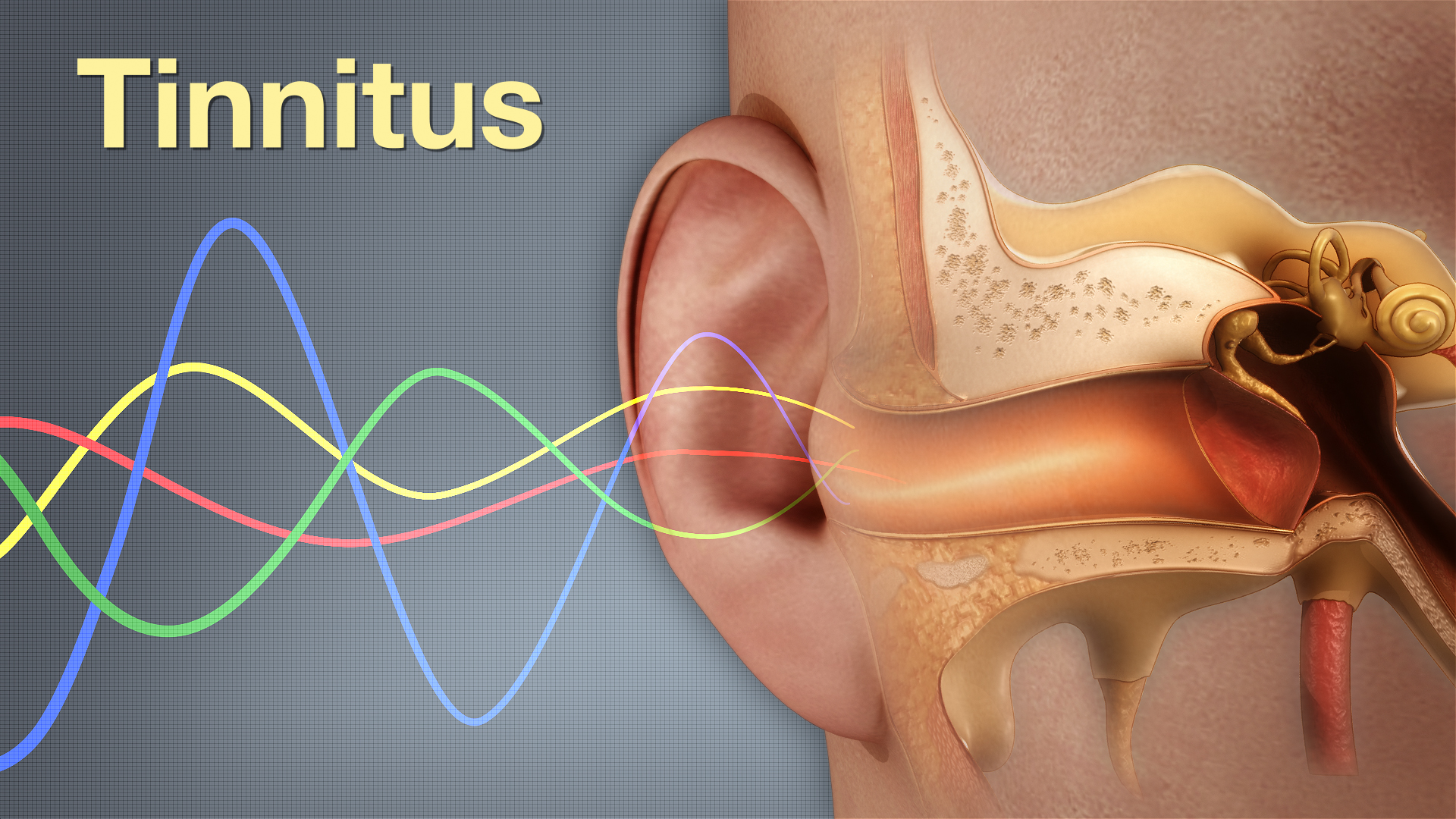 What is In-Ear Tinnitus